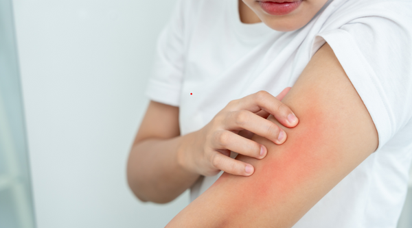 Close up of a woman scratching a dry itchy red skin rash on her arm caused by hard water irritation and chlorine exposure during a shower