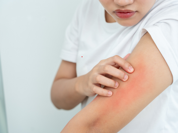 Close up of a woman scratching a dry itchy red skin rash on her arm caused by hard water irritation and chlorine exposure during a shower