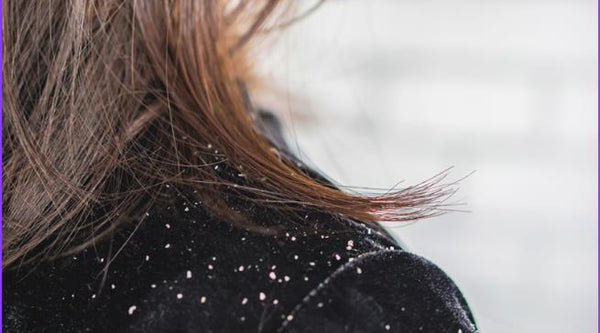 Side view of a woman with brown hair showing white dandruff flakes fallen onto the shoulder of her black velvet jacket due to dry scalp irritation from hard water