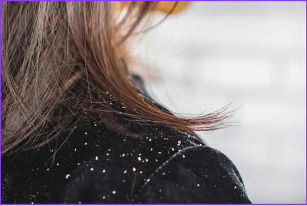 Side view of a woman with brown hair showing white dandruff flakes fallen onto the shoulder of her black velvet jacket due to dry scalp irritation from hard water