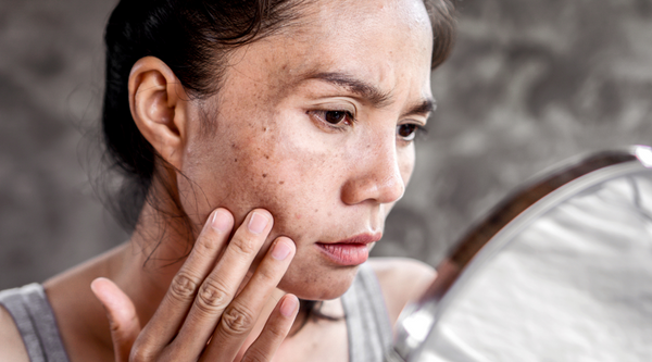 A woman looking closely in a mirror at skin acne breakouts and blemishes caused by washing her face with harsh chlorinated hard water