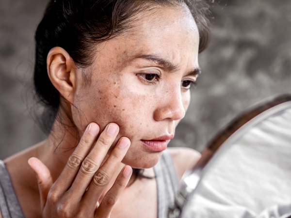A woman looking closely in a mirror at skin acne breakouts and blemishes caused by washing her face with harsh chlorinated hard water